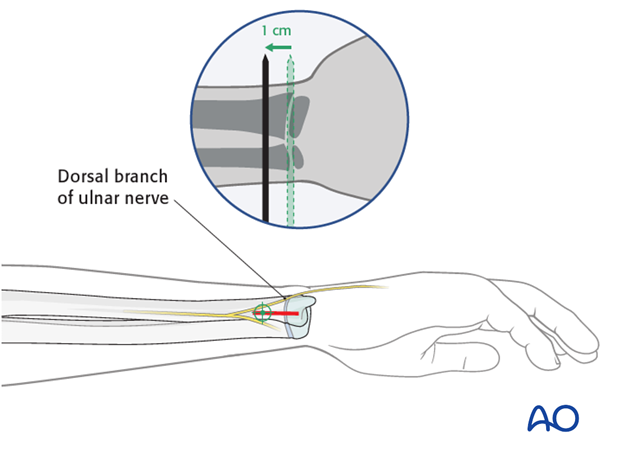 ESIN - Distal medial entry point to the ulna