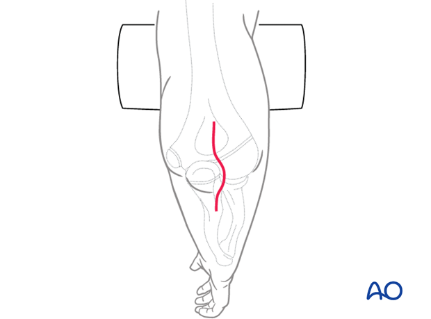 Posterior approach to the ulna