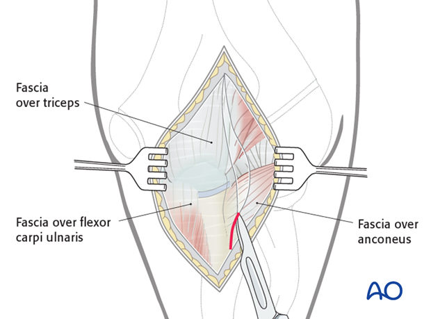 Posterior approach - Dissection