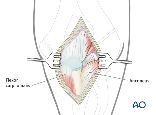 Posterior approach - Dissection