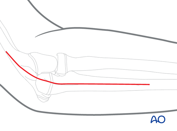 Posterolateral (Boyd) approach to the proximal radius and ulna