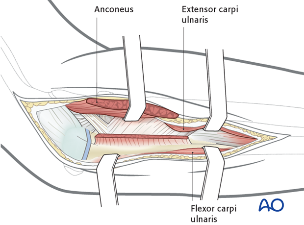 Posterolateral approach - Exposure of posterior surface of the ulna