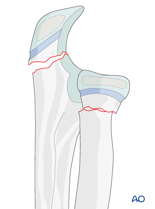 Combination of radial and ulnar fractures