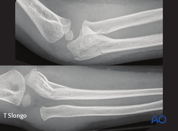 Monteggia lesion with proximal (metaphyseal) ulnar fracture