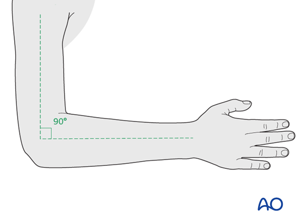 Cast immobilization - Arm position