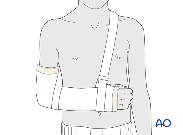 Cast immobilization - The arm is supported in an arm sling around the shoulder.