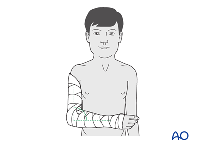 Splint Immobilization For Ulna, Avulsion Of Coronoid