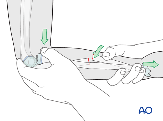 Cast immobilization for Monteggia lesion - Reduction maneuvers for complete fractures