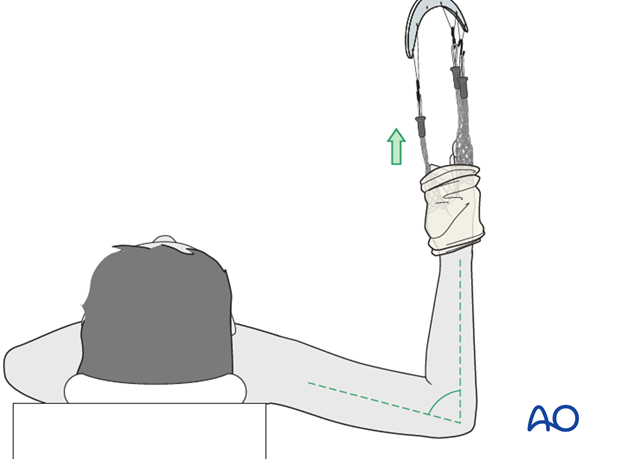 Cast immobilization for Monteggia lesion - Arm position