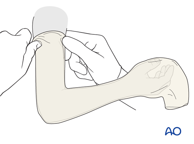 Cast immobilization for Monteggia lesion - Application of tubular bandage