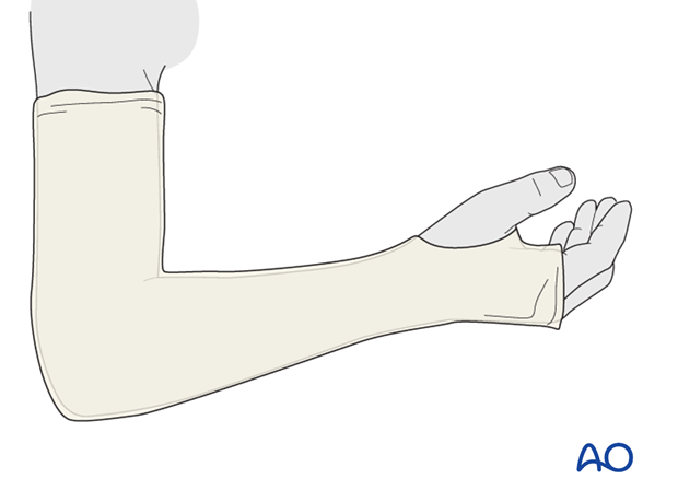 Cast immobilization for Monteggia lesion - Application of tubular bandage