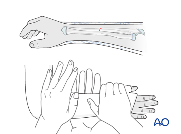 Cast immobilization for Monteggia lesion - Molding the cast