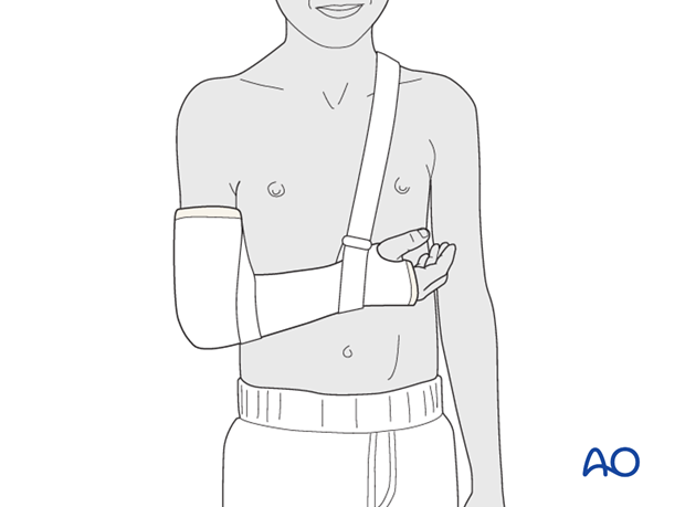 Cast immobilization for Monteggia lesion - Support with a sling