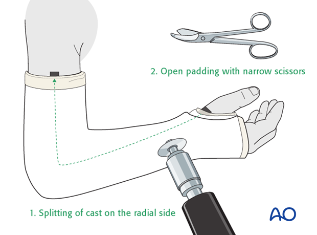 Cast immobilization for Monteggia lesion - Cast splitting