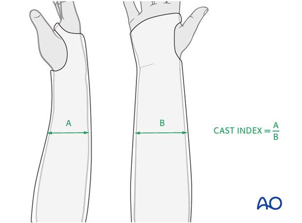 Cast immobilization for Monteggia lesion - X-ray evaluation of the cast