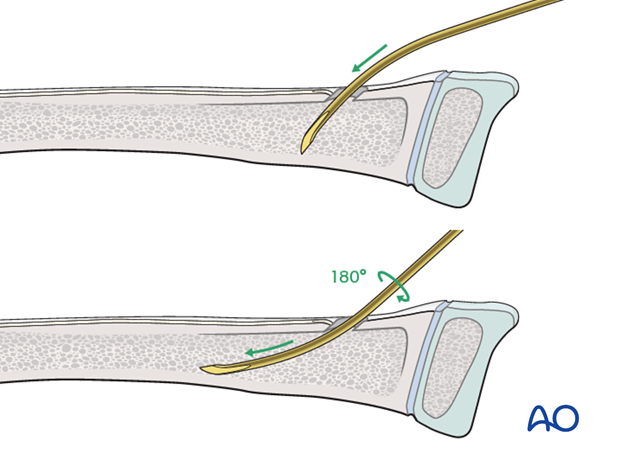 ESIN (radial neck) - Nail insertion