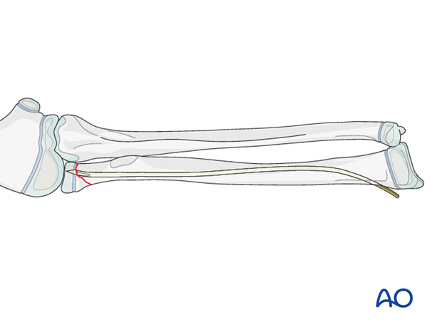 The ESIN method involves closed reduction and internal fixation with an elastic nail. 