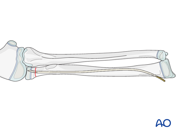 The ESIN method involves closed reduction and internal fixation with an elastic nail. 