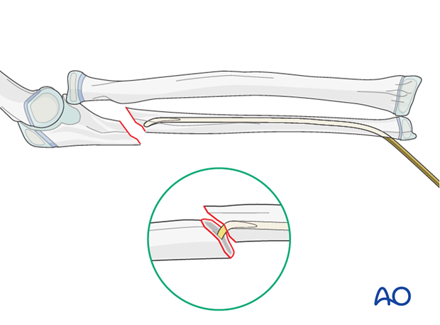 ESIN (ulna) - Reduction with nail