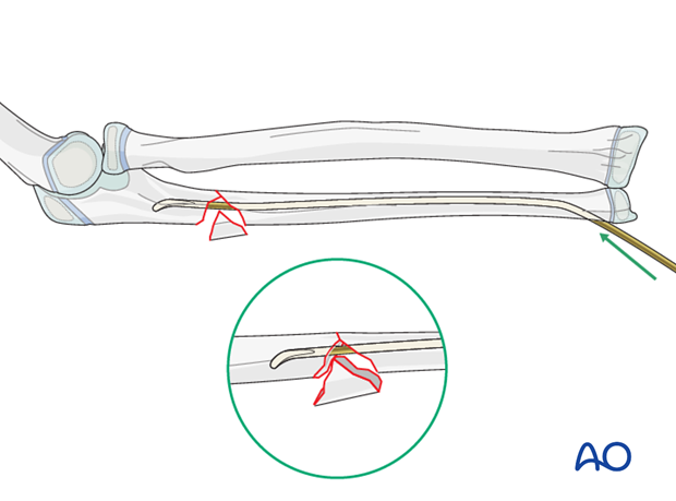 ESIN (ulna) - Reduction with nail