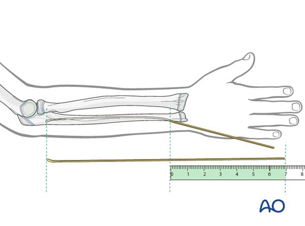 ESIN (ulna) - Estimation of nail length