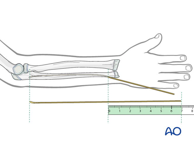 ESIN of the ulna (Monteggia lesion)