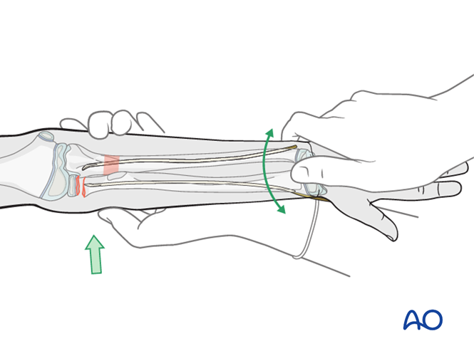 ESIN of the radius after ESIN of the ulna (Monteggia equivalent)