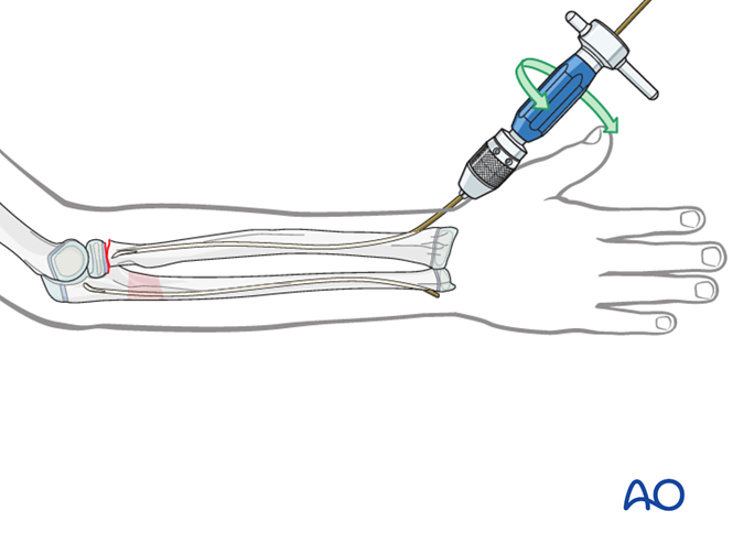 ESIN of the radius after ESIN of the ulna (Monteggia equivalent)