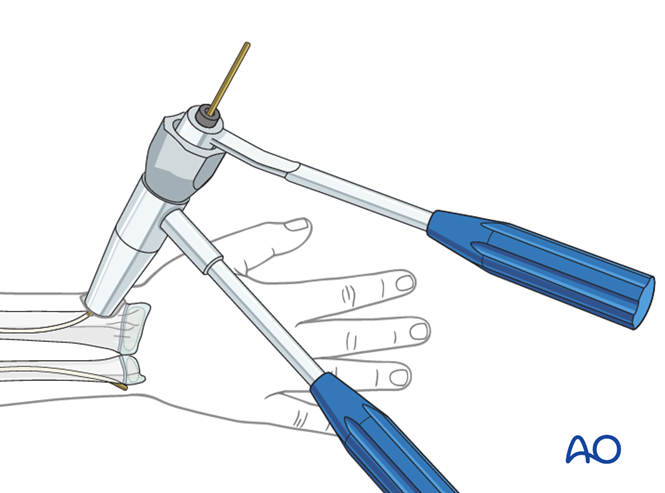 ESIN of the radius after ESIN of the ulna (Monteggia equivalent)