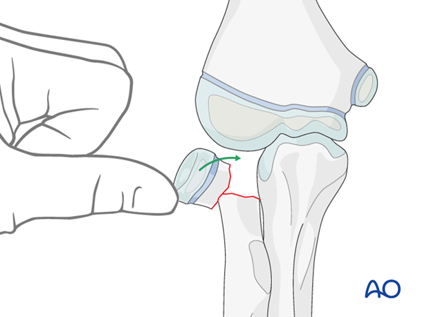 Open reduction; K-wire fixation - Manual reduction