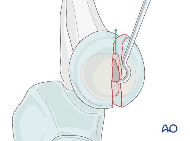Radial head lag screw - Reduction of unstable fractures