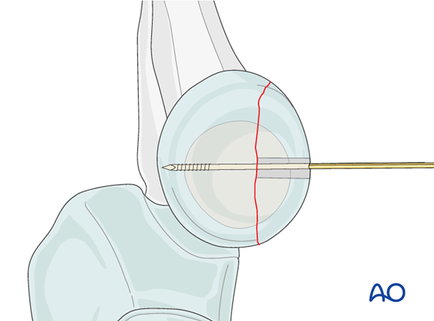 Radial head lag screw - Drilling