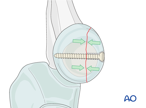 Radial head lag screw insertion