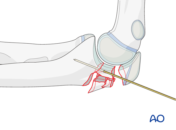 Open reduction; plate fixation (olecranon) - Reduction of articular fragments