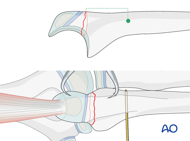 Open reduction; tension band fixation - Drilling