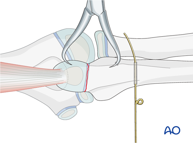 Open reduction; tension band fixation for Ulna, avulsion of apophysis