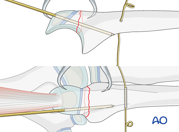 Open reduction; tension band fixation - K-wire insertion