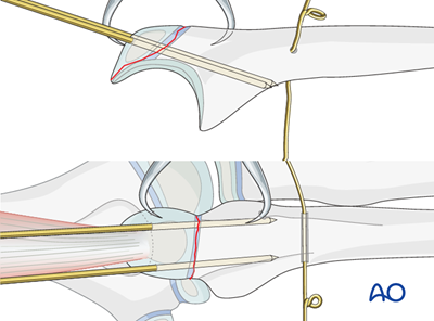 Open reduction; tension band fixation for Ulna, avulsion of apophysis