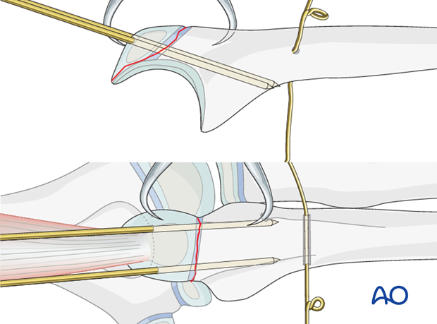 Open reduction; tension band fixation - K-wire insertion