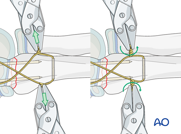 Open reduction; tension band fixation - Wire fixation