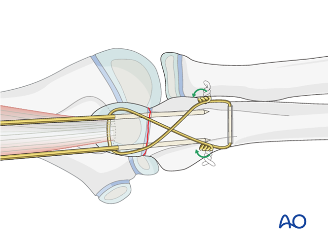 Open reduction; tension band fixation for Ulna, avulsion of apophysis