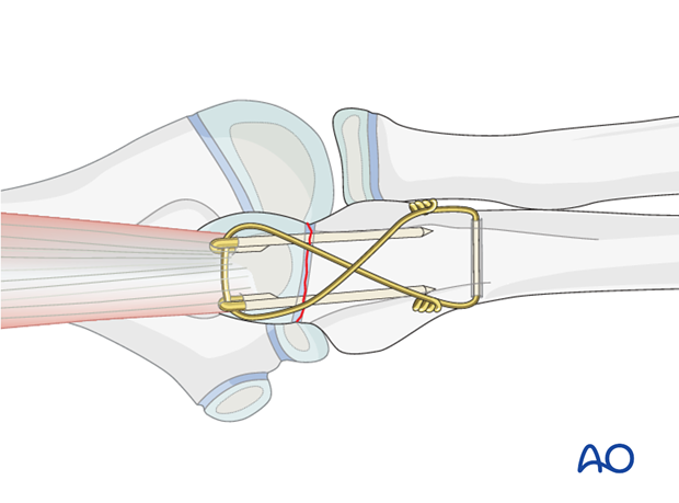 Open reduction; tension band fixation - Sinking the K-wires