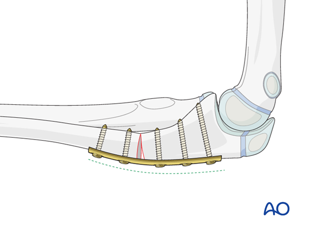 Ulnar osteotomy for plastic deformity