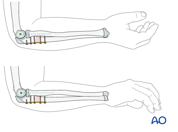 Assessing the radial head position