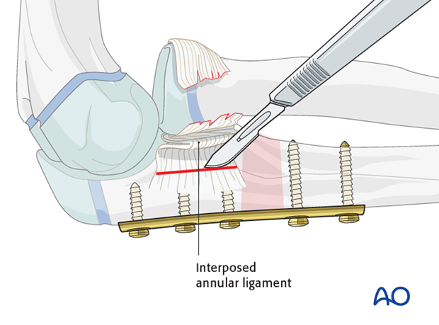 Open reduction; plate fixation (Monteggia lesion) - Removal of blocks to reduction