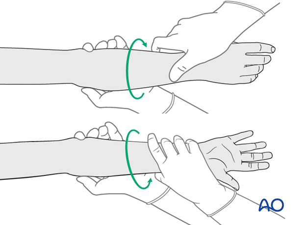 Open reduction; plate fixation (Monteggia lesion) - Checking forearm rotation
