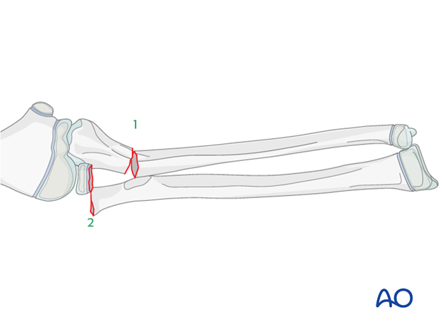 Open reduction; plate fixation (ulna) - Order of reduction and fixation