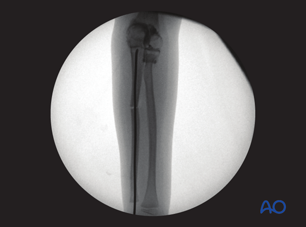 ESIN (Monteggia lesion) - Ulnar osteotomy for plastic deformity