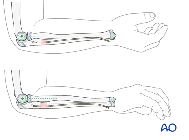 ESIN (Monteggia lesion) - Assessing radial head position