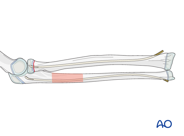 The ESIN method involves closed reduction and internal fixation with an elastic nail.